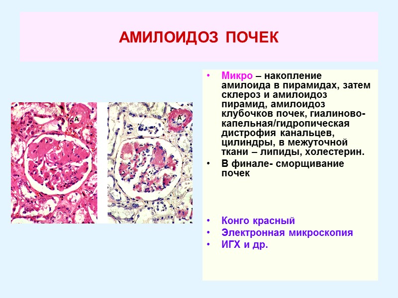 АМИЛОИДОЗ ПОЧЕК Микро – накопление амилоида в пирамидах, затем склероз и амилоидоз пирамид, амилоидоз